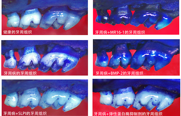 新潟大学发现SLPI蛋白参与牙周病重症化进程，提示候选治疗药物