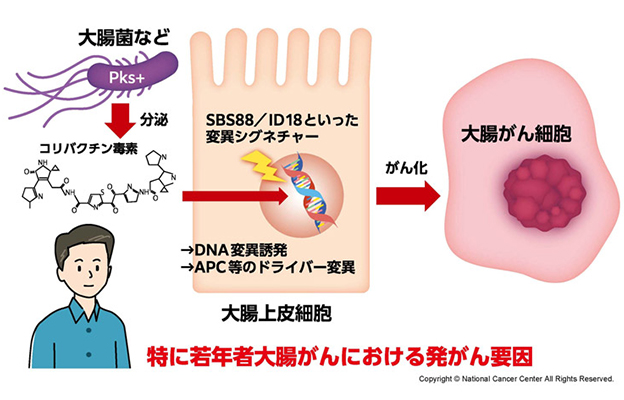日本国立癌症研究中心：约半数大肠癌或与肠道菌群相关，分泌毒素会引发特定基因突变