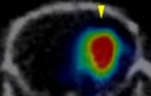 横滨市立大学：放射性药物局部给药对小鼠恶性脑肿瘤有效
