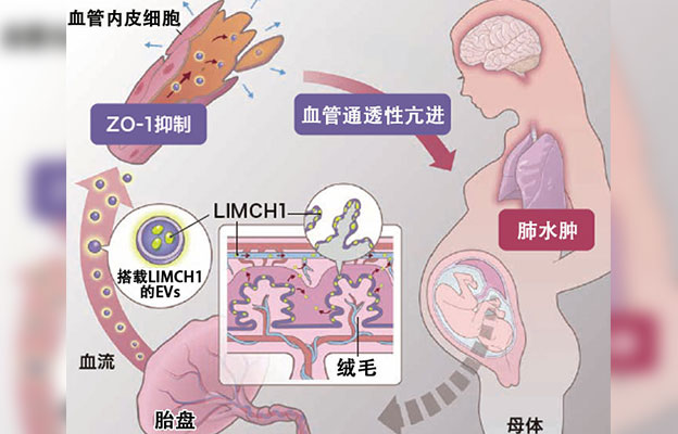 名古屋大学揭示早发型子痫前期发病机制，胎盘来源的细胞外囊泡蛋白参与疾病进程