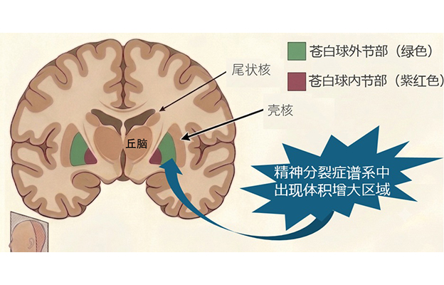 东京大学调查300多人MRI图像发现精神分裂症患者脑部外形特征——苍白球外节部体积增大