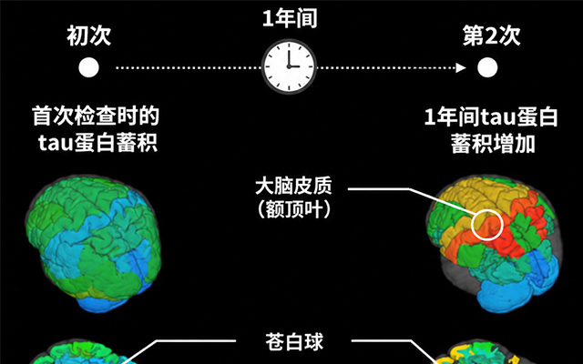 QST首次证实进行性核上性麻痹患者脑内的tau蛋白持续增加，并与症状进展相关