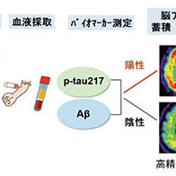 东京大学等通过血液检测预测阿尔茨海默病，有望实现早期诊断