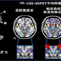 QST开发出可捕捉帕金森病致病因子的PET，全球首次实现在活体大脑中的可视化