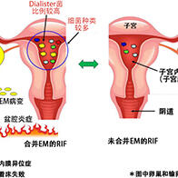 山梨大学等研究发现反复着床失败的子宫内膜异位症患者的子宫中高概率存在牙周病菌