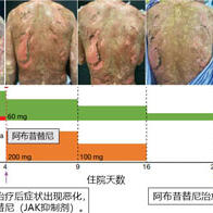 新潟大学等开发出治疗致命性重症药疹的新疗法，使用抑制剂取得良好效果