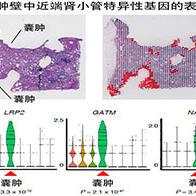 日本国立癌研与东京大学明确透析患者特有的肾癌在囊肿形成后的发病机制