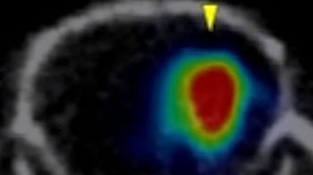 横滨市立大学：放射性药物局部给药对小鼠恶性脑肿瘤有效