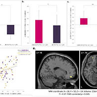 富山大学等研发出记忆干预程序：可缓解大脑反复回忆负面事件的倾向，有望用于压力相关精神障碍的预防与治疗