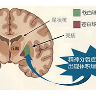 东京大学调查300多人MRI图像发现精神分裂症患者脑部外形特征——苍白球外节部体积增大