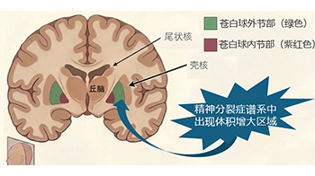 东京大学调查300多人MRI图像发现精神分裂症患者脑部外形特征——苍白球外节部体积增大