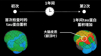 QST首次证实进行性核上性麻痹患者脑内的tau蛋白持续增加，并与症状进展相关