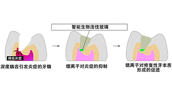 大阪大学开发可分阶段释放离子的玻璃粒子，有望实现“无需拔除牙神经”的龋齿治疗