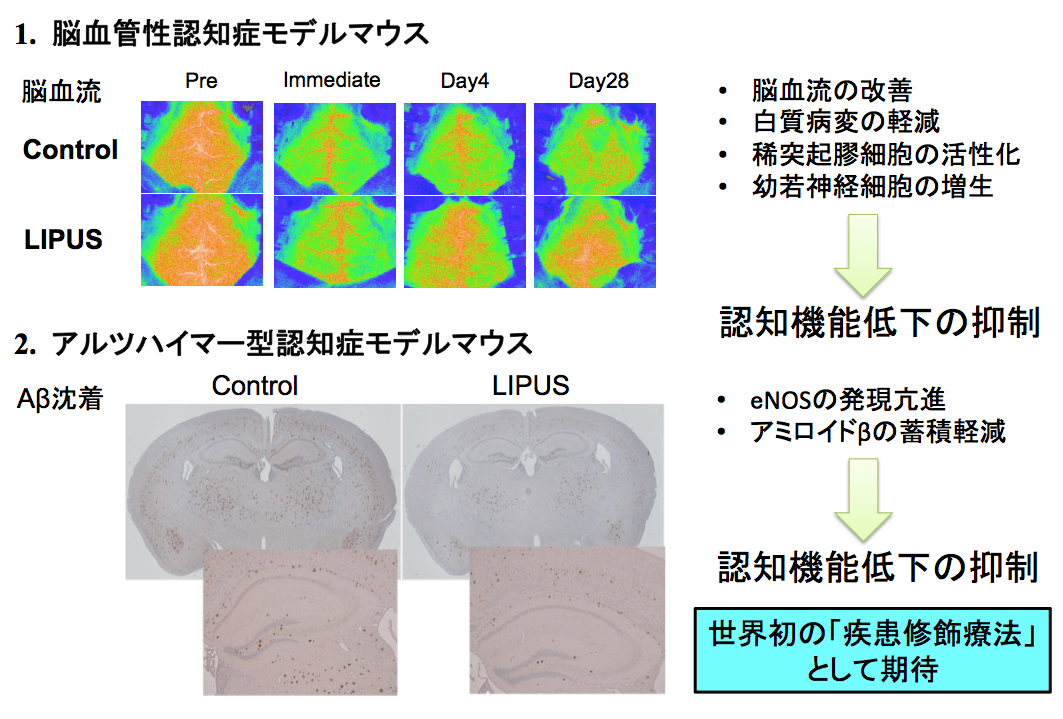 日本研发出照射超声波缓解老年痴呆的新型疗法