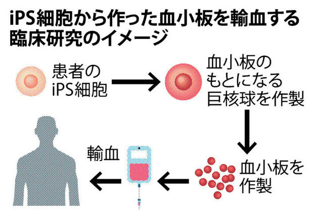 iPS细胞制备的血小板输血临床研究示意图