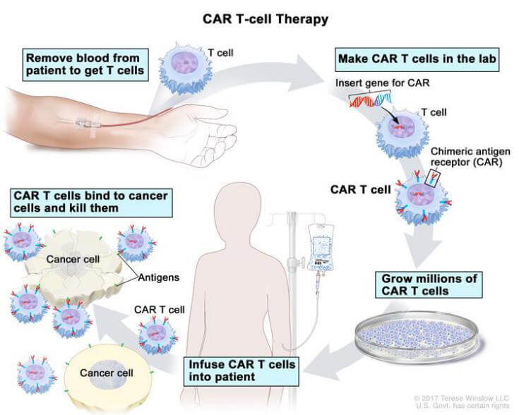 嵌合抗原受体T细胞疗法