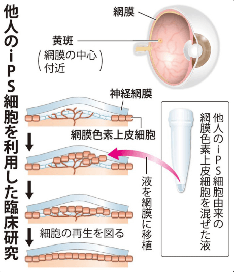 日本ips细胞研究报告 廿九 理研篇 确认视网膜移植试验安全性 客观日本